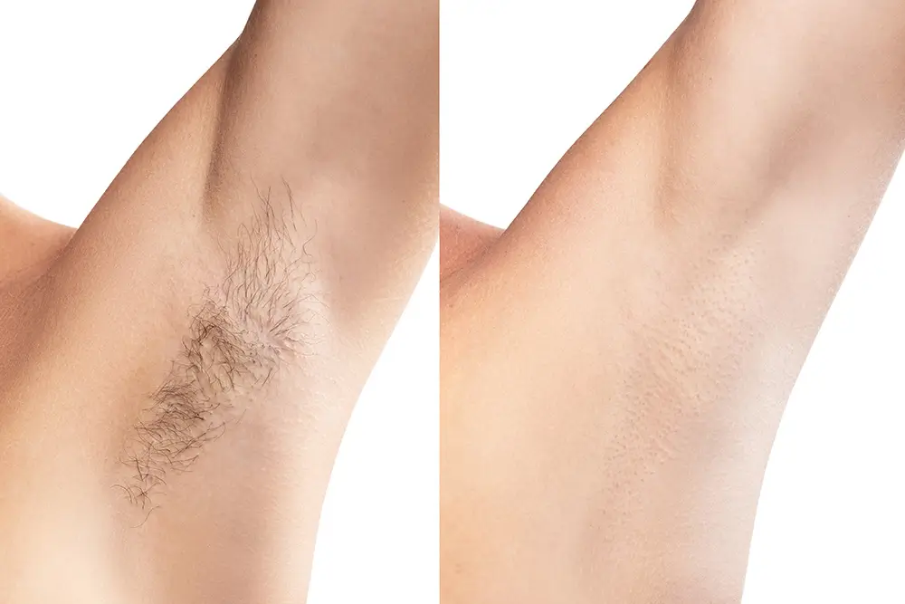 laser hair removal Chicago