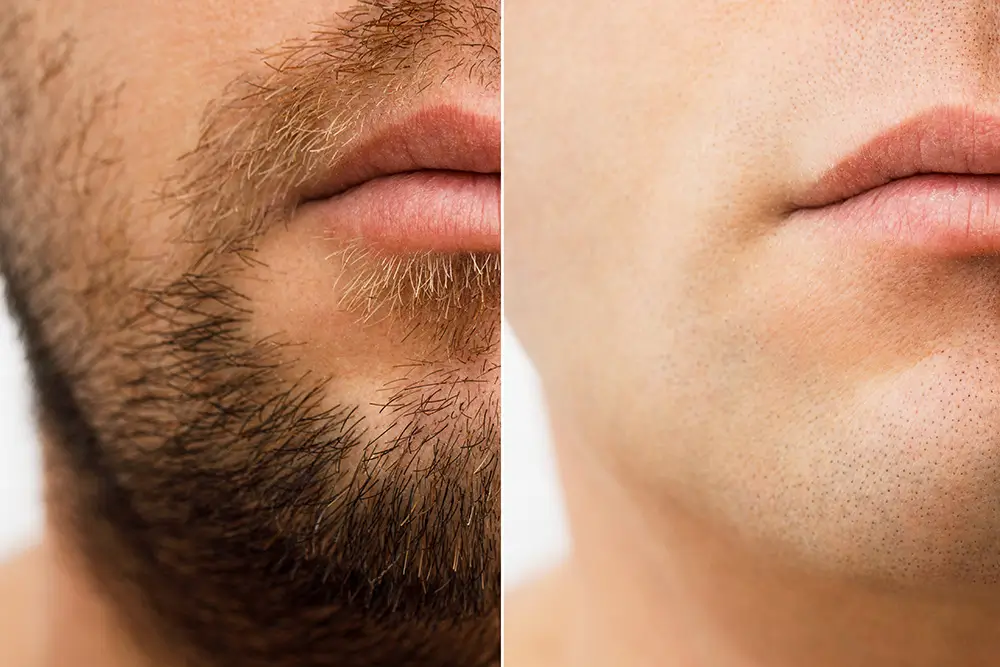 laser hair removal before and after