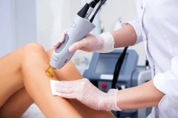 Laser Hair Removal on Legs