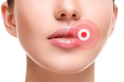 cold sores