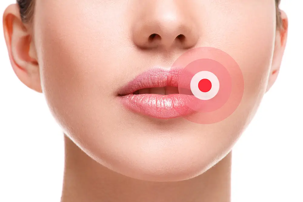 cold sores